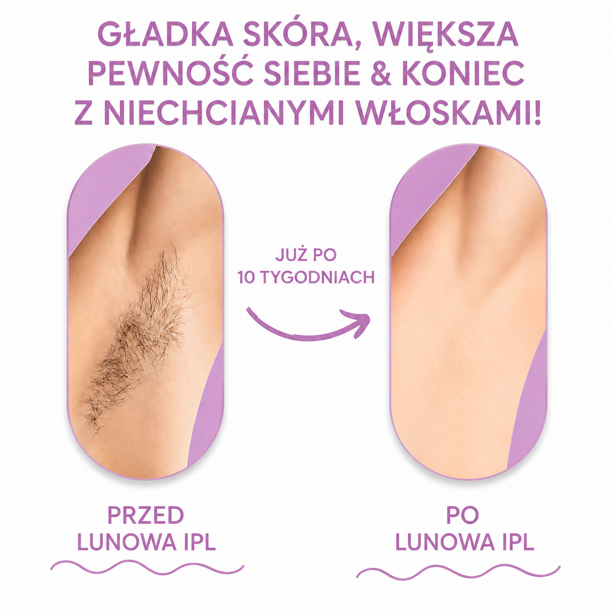 Lunowa IPL I Najlepsza metoda depilacji laserowej do użytku domowego
